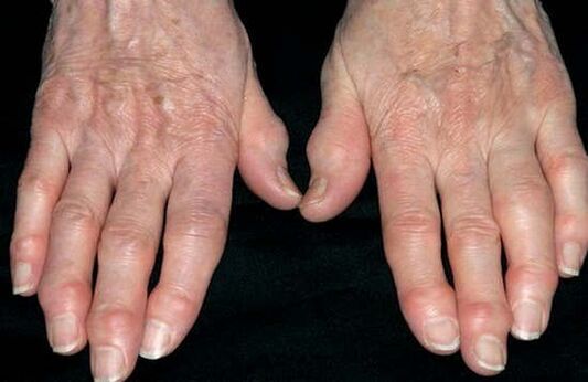 Osteoarthritis der Hände