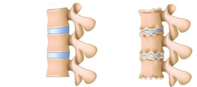 Was ist Osteochondrose
