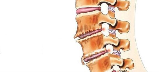Was ist Spondylose