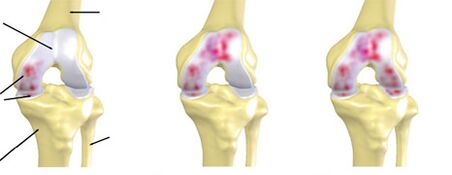 Grad der Arthrose