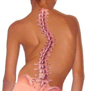 Eine Krümmung der Wirbelsäule führt zu Osteochondrose
