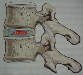 Erstes Stadium der Osteochondrose